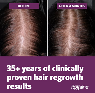 Rogaine Women's 5% Minoxidil Topical Aerosol Hair Regrowth Treatment