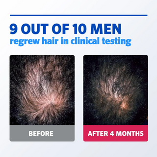 Men's Rogaine Hair Regrowth Treatment